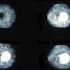 Fibrovascular PED Fibrovascular PED